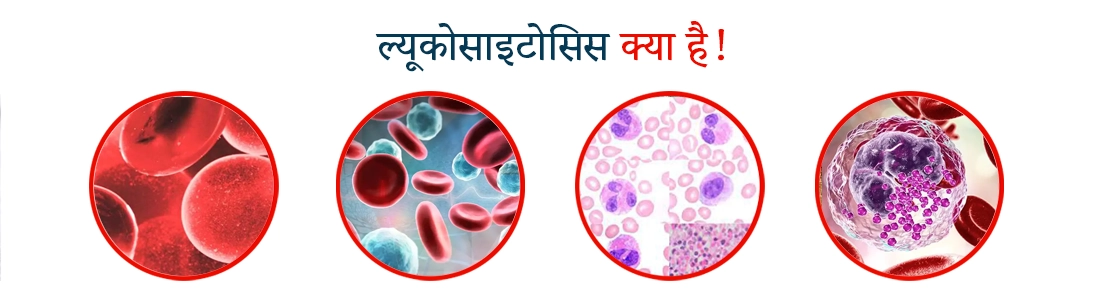 What is Leukocytosis in Hindi
